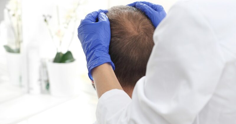 Nadzieja dla łysiejących mężczyzn. Naukowcy odkryli „przełącznik”. To może być przełom