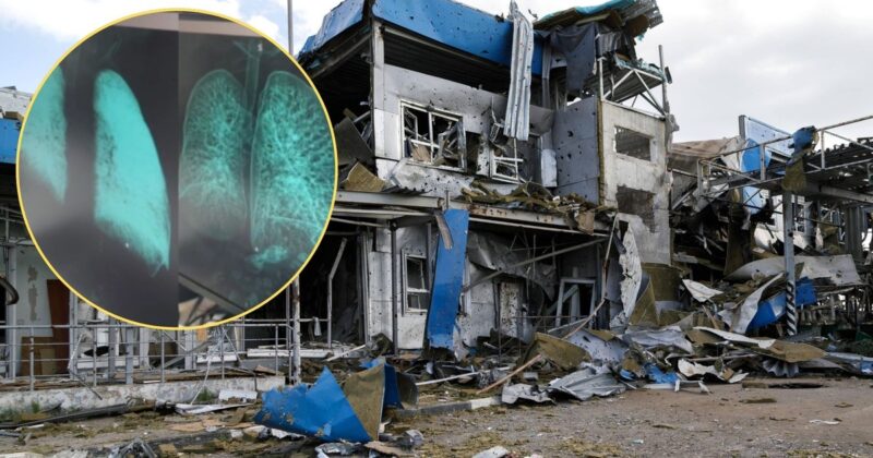 Pokazali płuca rosyjskiego żołnierza. Miał brać udział w operacji „Potok”